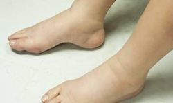 Vücutta bir gram ödem bırakmıyor! Toksinleri 72 saatte atıyor