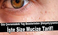 Göz Çevrenizdeki Yağ Bezelerinden Şikâyetçiyseniz İşte Size Mucize Tarif!