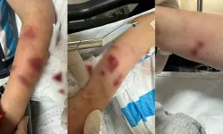 Sokak köpeklerinin saldırısına uğrayan çocuk yaralandı