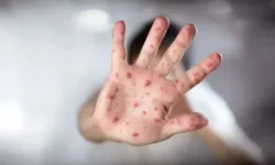 Kapıdaki büyük tehlike: Kızamık geri döndü