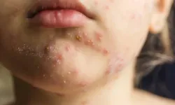 ABD’de kızamık vakaları hızla artıyor
