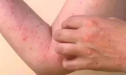 DSÖ'nün uyardığı Chikungunya virüsü tehlikeli değil