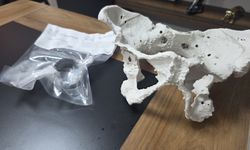 60 yaşındaki kadın 3D yazıcıyla üretilen kalça proteziyle sağlığına kavuştu