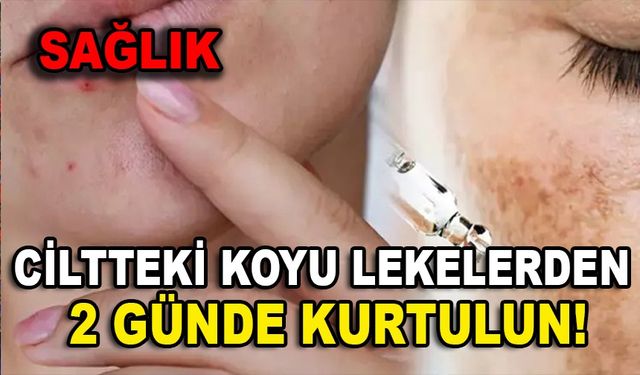 Ciltteki koyu lekelerden 2 günde kurtulun! 5 doğal malzemeden gelen mucize