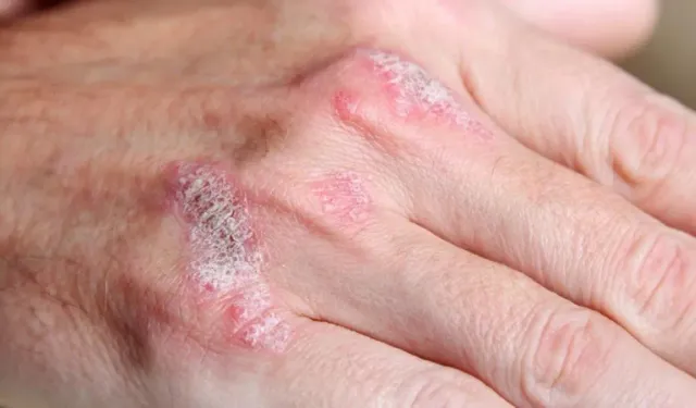 Sedef romatizmasının hasarı tedaviyle önleniyor