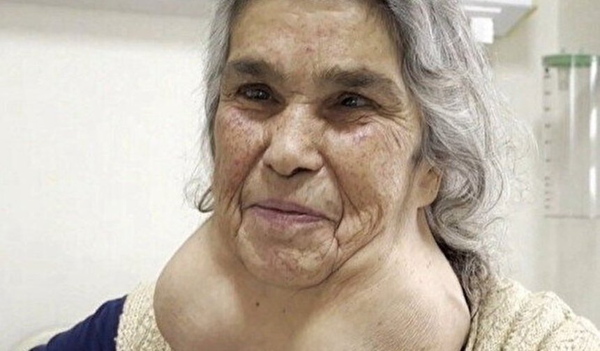 Nedenini duyan inanamadı: Yıllarca boynundaki devasa kitleyle yaşadı