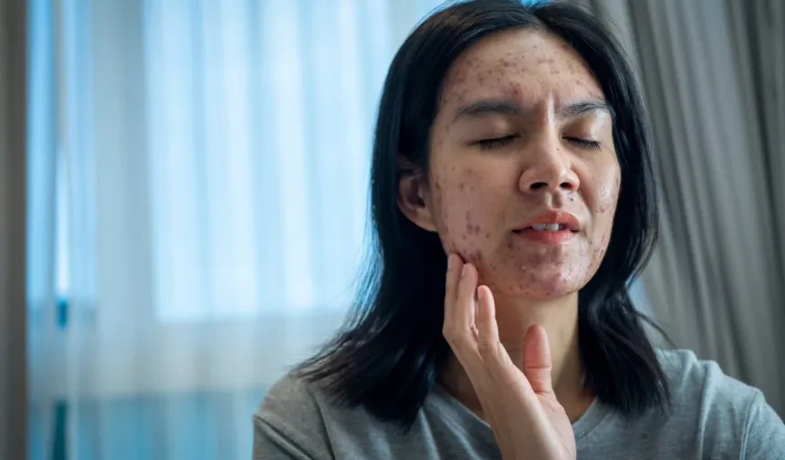 Lupus hastalığı hakkında bilmeniz gerekenler