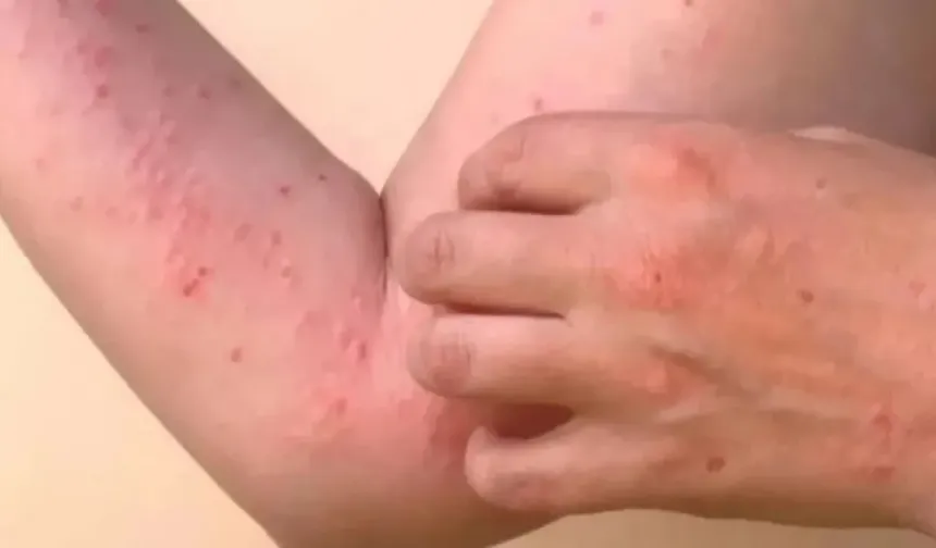 DSÖ'nün uyardığı Chikungunya virüsü tehlikeli değil